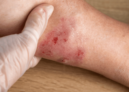 Close-up of a healthcare professional examining a patient's wound on the forearm, highlighting signs of irritation and potential infection, relevant to diabetic foot ulcer prevention and chronic wound care.
