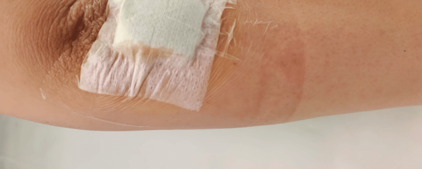 Arm with a bandage covering a wound, showcasing skin texture and healing process.