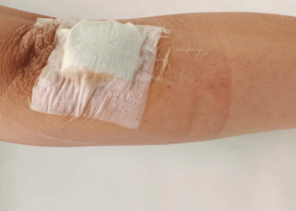 Arm with a wound dressing, showcasing wound care treatment relevant to diabetic foot ulcers and chronic wounds.