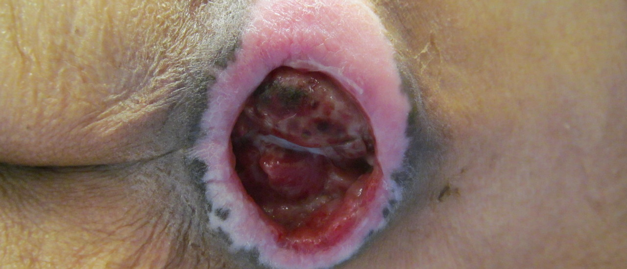 Close-up of a sacral ulcer, showing the wound's depth and surrounding skin, relevant to wound care and treatment information on sacral ulcers.