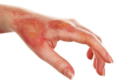 Burned hand with visible redness and blistering, illustrating the impact of thermal injuries and the need for specialized wound care.