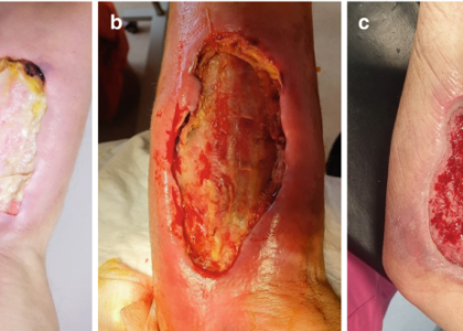Images of various chronic wounds showing different stages of healing and tissue damage, relevant to advanced wound care treatments and patient management.