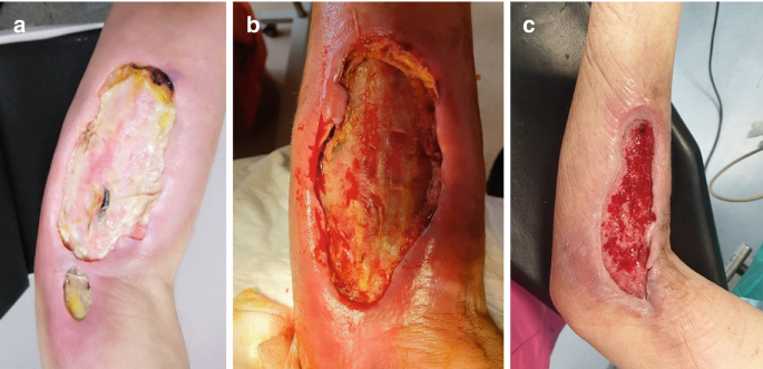 Images of complex wounds showing varying degrees of tissue damage and healing challenges, relevant to post-trauma wound care and treatment options.