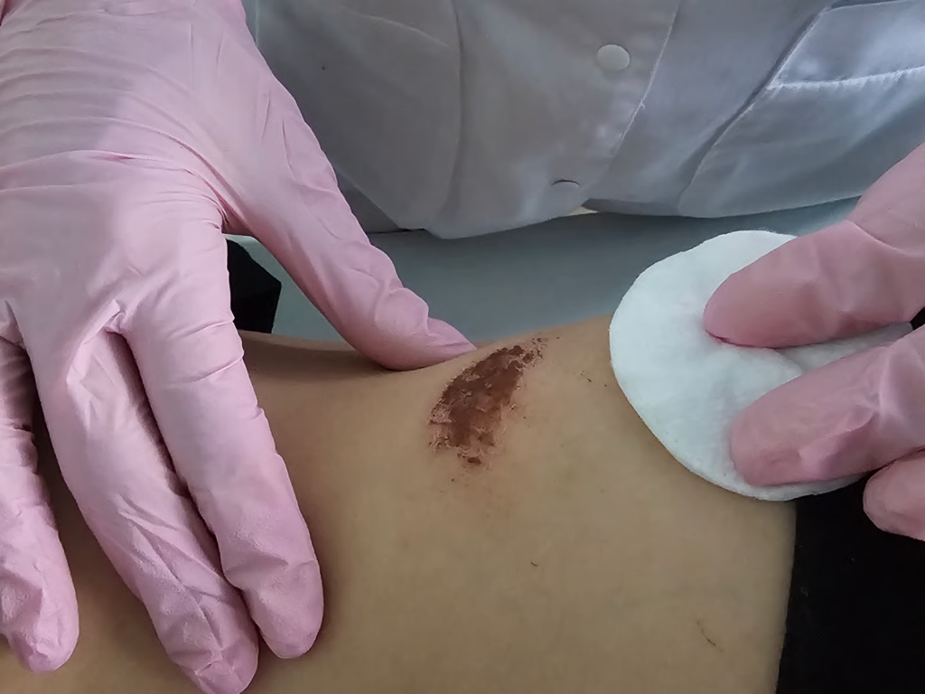 Healthcare professional cleaning a chronic wound on a patient's arm, emphasizing non-healing wound care and treatment.