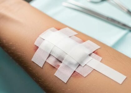 Close-up of a properly dressed wound on an arm, demonstrating effective wound care techniques and emphasizing the importance of proper treatment for optimal healing.